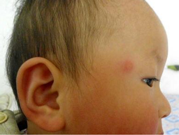 脸上长大疙瘩里面硬的，非比寻常的大疙瘩  疙瘩 硬的 美白祛黄 第4张