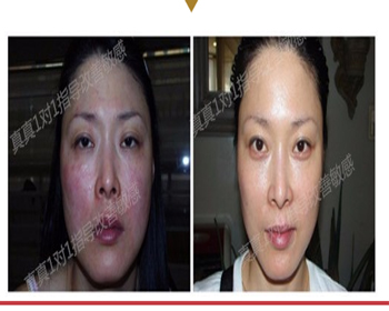 最新解析抗敏的正确护理方式  抗敏 美白祛黄 第4张