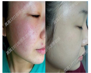 最新解析抗敏的正确护理方式  抗敏 美白祛黄 第5张