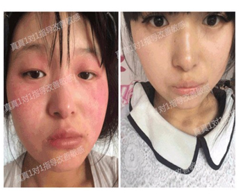 最新解析抗敏的正确护理方式  抗敏 美白祛黄 第6张