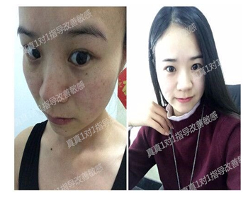 最新解析抗敏的正确护理方式  抗敏 美白祛黄 第7张