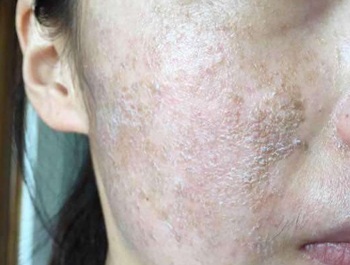 激素脸结痂后会好吗，肌肤症状要深究