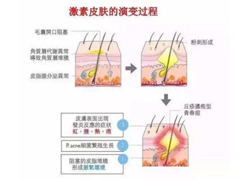如何判断是不是激素脸的几个参考项  激素 美白祛黄 第2张