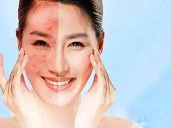 如何判断是不是激素脸的几个参考项  激素 美白祛黄 第4张