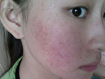 tst活酵母激素脸排毒期真的有效吗  酵母 激素 美白祛黄 第4张