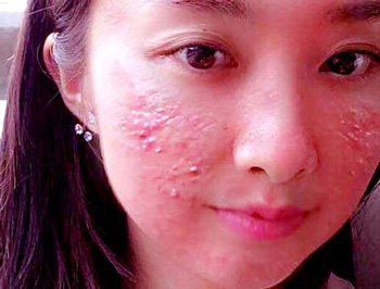 严重的激素脸怎么调理，学会4种方法  激素脸 调理 美白祛黄 第2张