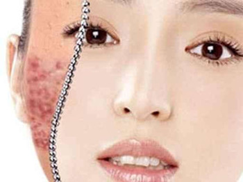 激素脸黑斑怎么解决，用对方法才能改善皮肤  黑斑 激素 美白祛黄 第2张