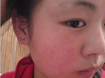 脸上过敏红血丝怎么办，逐步解决恢复健康肌肤  红血丝 怎么办 美白祛黄 第2张