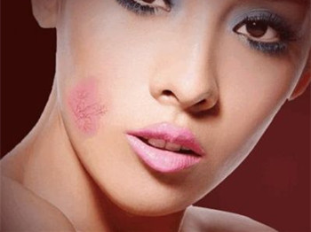 脸上过敏红血丝怎么办，逐步解决恢复健康肌肤  红血丝 怎么办 美白祛黄 第3张