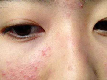 激素脸我自己治好了，最真实的经验分享