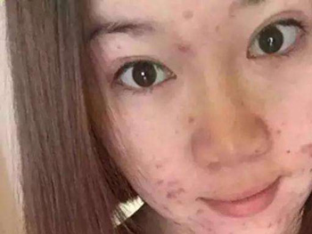 激素脸我自己治好了，最真实的经验分享  激素脸 美白祛黄 第2张