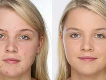 激素脸什么时候能好，分情况决定好的速度