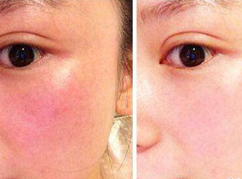 激素脸什么时候能好，分情况决定好的速度  激素脸 美白祛黄 第2张