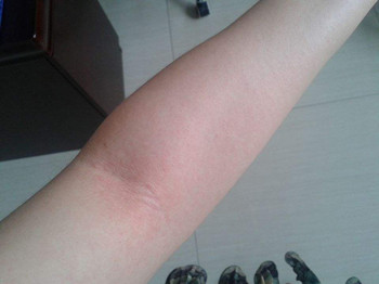 护肤品过敏测试怎么做，简单好学的方法  护肤品 过敏 美白祛黄 第4张