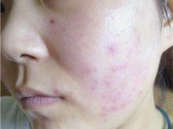 怎么判断护肤品过敏，避免肌肤出问题  护肤品 美白祛黄 第2张