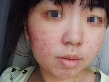 过敏皮肤能用化妆品吗，小心毁容哦