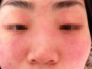 过敏皮肤能用化妆品吗，小心毁容哦  过敏皮肤 美白祛黄 第2张