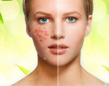 激素脸反复过敏怎么办，五种方法解救肌肤