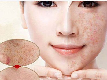 轻度激素脸有什么症状，怎么调理