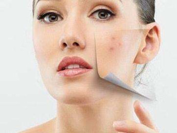 轻度激素脸有什么症状，怎么调理  轻度激素脸 美白祛黄 第3张