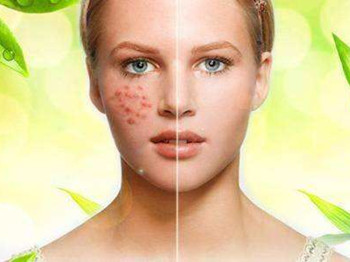 轻度激素脸有什么症状，怎么调理  轻度激素脸 美白祛黄 第4张