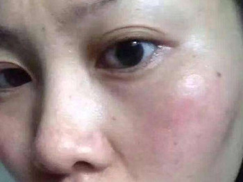 激素脸如何调理，要对症治疗  激素脸 美白祛黄 第2张