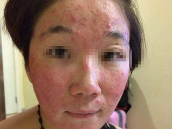 激素脸如何调理，要对症治疗  激素脸 美白祛黄 第3张