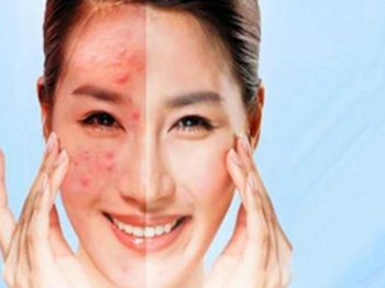 激素脸如何调理，要对症治疗  激素脸 美白祛黄 第4张