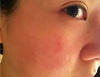 激素过敏脸能自愈吗，如何治疗
