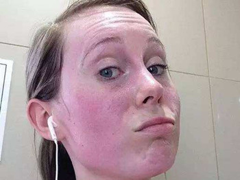 脸又红又肿又痒还很烫怎么办