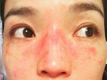 脸又红又肿又痒还很烫怎么办  过敏 激素脸 美白祛黄 第4张