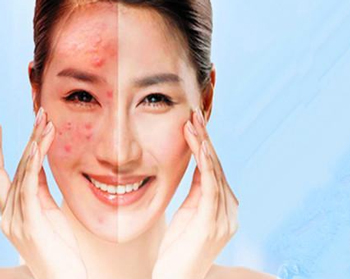 糖皮质激素脸怎么治疗，必看治疗方法