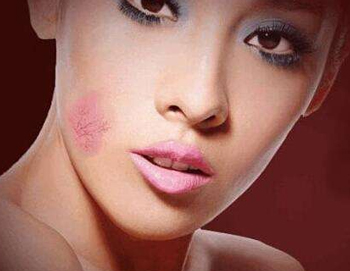 激素脸与敏感肌肤差异，四点必看  激素脸 敏感肌肤 美白祛黄 第3张