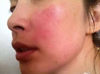 激素脸与敏感肌肤差异，四点必看  激素脸 敏感肌肤 美白祛黄 第4张