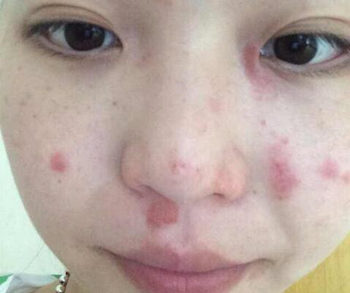 皮肤干燥过敏怎么办啊，分析原因和四大解决办法