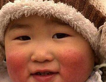 皮肤干燥过敏怎么办啊，分析原因和四大解决办法  皮肤干燥 过敏 美白祛黄 第2张