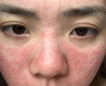 激素皮炎可以用雅漾吗  雅漾 激素脸 美白祛黄 第2张