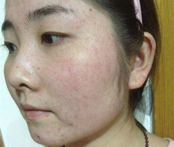 雅施美洋甘菊治疗激素脸吗  激素脸 美白祛黄 第2张