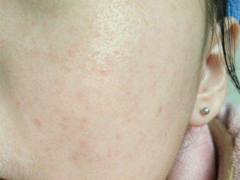 逆光疹子激素脸能好吗