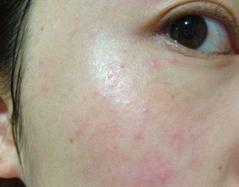 花之优品治疗激素脸吗  激素脸 美白祛黄 第2张