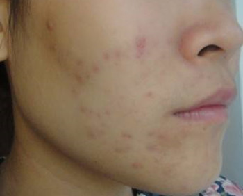 激素脸长痘痘怎么办，如何消除  激素脸 怎么办 美白祛黄 第2张