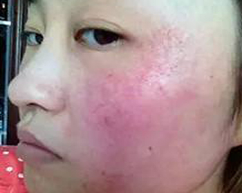 激素脸怎样才算修复期