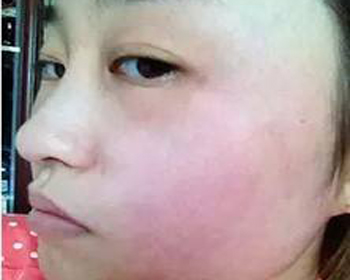 激素脸怎样才算修复期  激素脸 美白祛黄 第2张