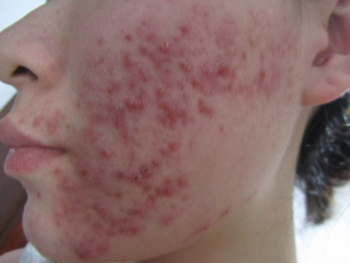 激素脸排异分几个阶段