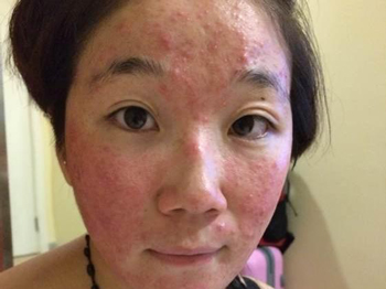 激素脸排异分几个阶段  激素脸 美白祛黄 第2张