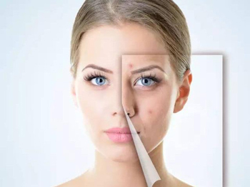 激素脸排异分几个阶段  激素脸 美白祛黄 第3张