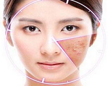 怎样证明激素脸恢复了