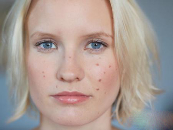 怎样证明激素脸恢复了  激素脸 美白祛黄 第2张