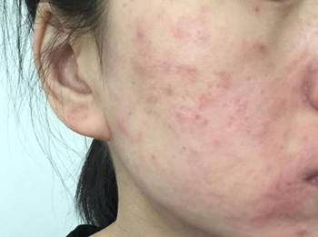 激素性皮炎反复发作是什么原因