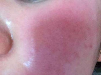 激素性皮炎反复发作是什么原因  激素脸 美白祛黄 第2张